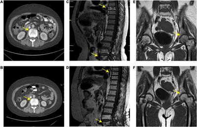 Clinical use of HD-MTX monotherapy in a rare case of refractory primary bone diffuse large B-cell lymphoma with long-term survival after local radiotherapy: A case report